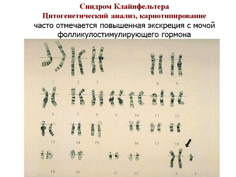 Синдром Клайнфельтера Цитогенетический анализ, кариотипирование часто отмечается повышенная экскреция с мочой фолликулостимулирующего гормона